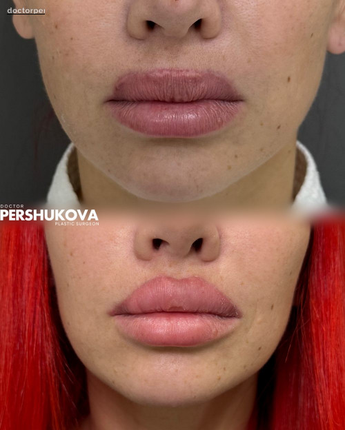 Пластика губ (третичная) «КЕССЕЛЬРИНГ» и пластика «V-Y»: до и через 7 дней после операции с результатом. Первые две операции проводились у сторонних специалистов