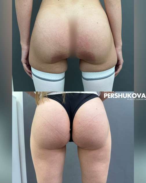 Коррекция формы ягодиц полимолочной кислотой с коррекцией подъягодичной складки: фото результата